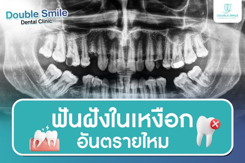 ฟันฝังในเหงือก อันตรายไหม? เรื่องใกล้ตัวที่ไม่ควรมองข้าม