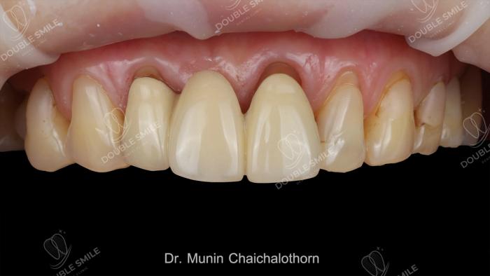 เคสรีวิวอุดฟันและวีเนียร์ 8