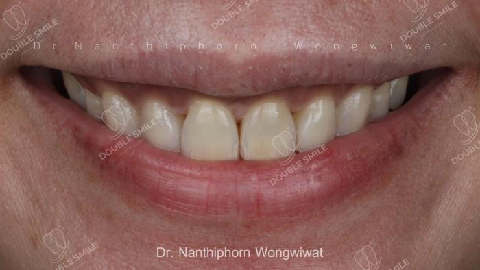 เคสรีวิวอุดฟันและวีเนียร์ 32