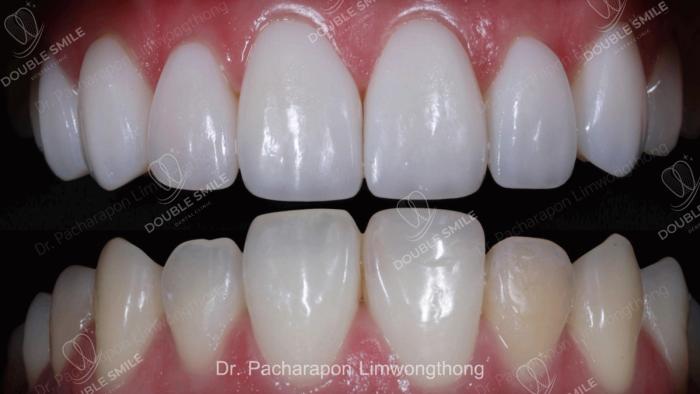 เคสรีวิวอุดฟันและวีเนียร์ 49