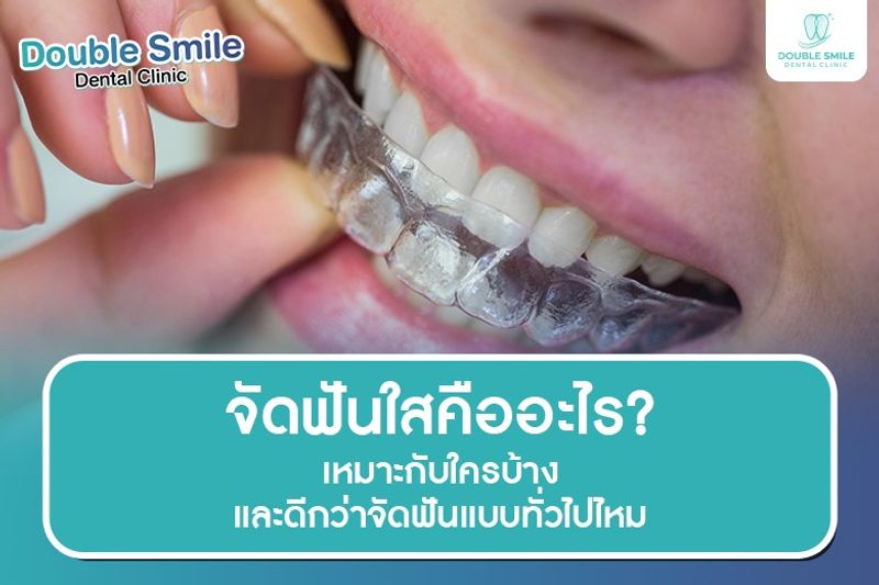 จัดฟันใสคืออะไร? เหมาะกับใครบ้าง