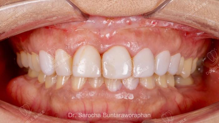 เคสรีวิวอุดฟันและวีเนียร์ 46