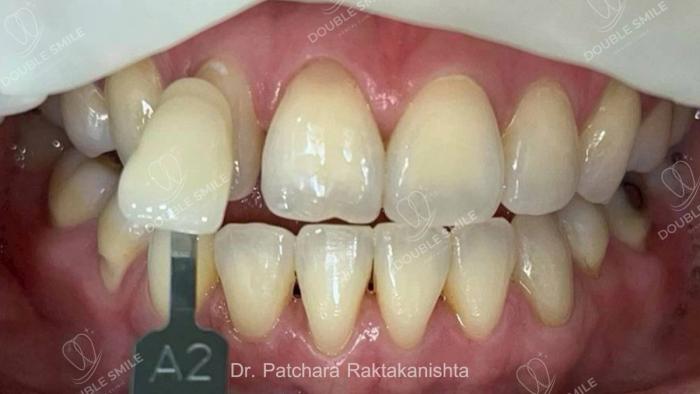 เคสรีวิวฟอกสีฟัน 17