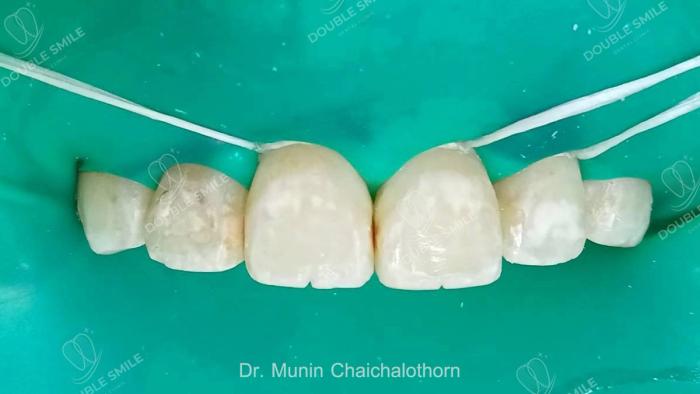 เคสรีวิวอุดฟันและวีเนียร์ 47