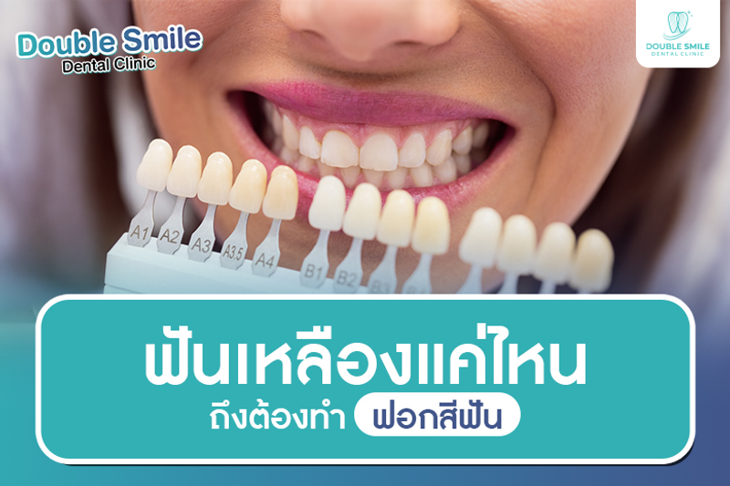 ฟันเหลืองแค่ไหน ถึงต้องทำฟอกสีฟัน?
