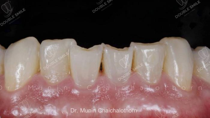 เคสรีวิวอุดฟันและวีเนียร์ 35