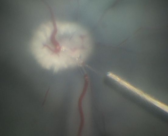 Retinales Gefäß nach erfolgreicher Punktion und Irrigation – Veränderung des Gefäßbildes infolge der erfolgreichen Flüssigkeitsinjektion mit dem Instrument