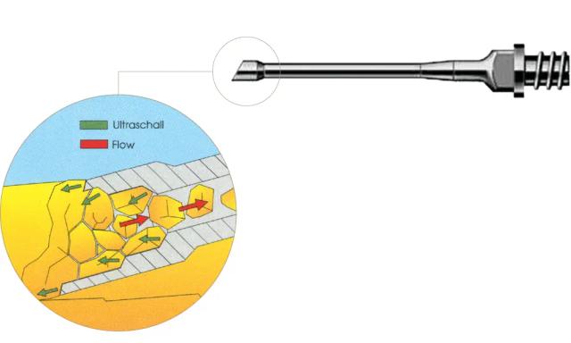Together with *H.-R. Koch*, Geuder develops the *mega ultrasound tip* for phaco with higher vacuum and lower energy. The *“Megatip”* remains Geuder’s bestselling phaco tip.