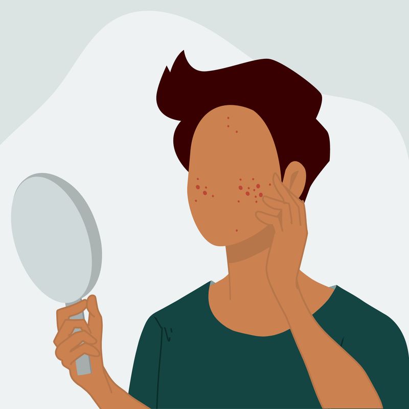 An illustration of a person, with a concerned body posture, suffering from acne 