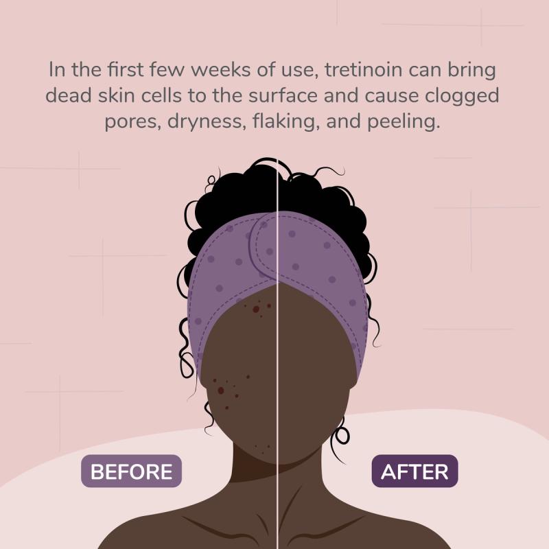 Illustration of Tretinoin Use Before and After Treatment. In the First Few Weeks of Use, Tretinoin Can Bring Dead Skin Cells to the Surface and Cause Clogged Pores, Dryness, Flaking, and Peeling.