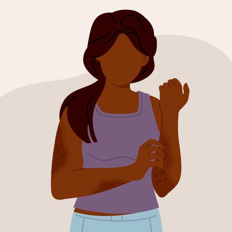 Illustration of a person affected by eczema.