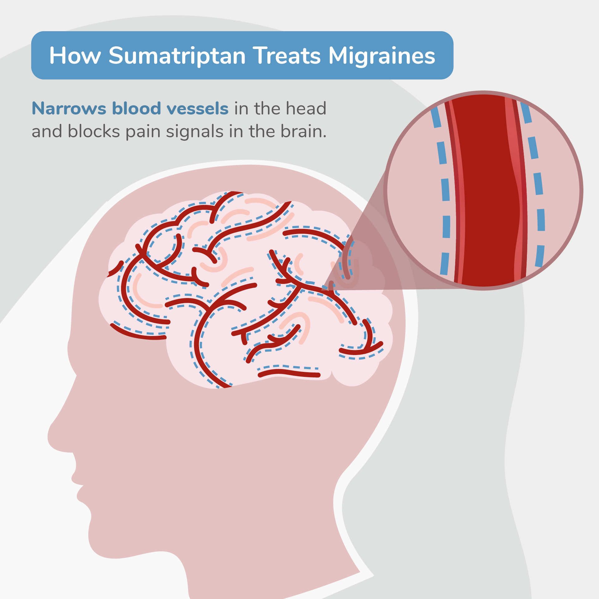 Compare Migraine Meds Rizatriptan Maxalt vs. Sumatriptan