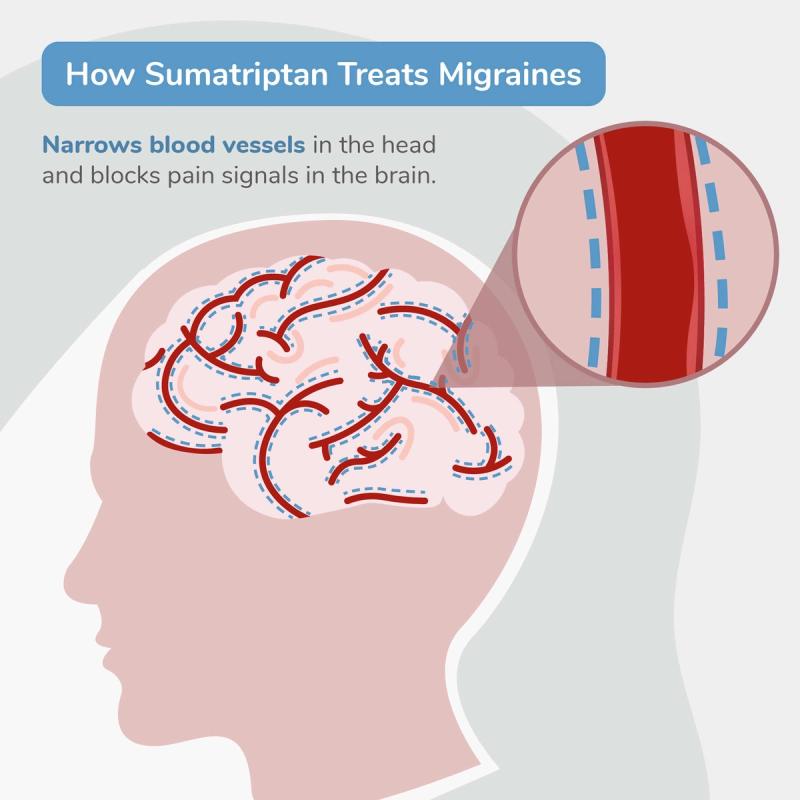 Illustration of Sumatriptan Treating a Migraine by Narrowing Blood Vessels in the Head and Blocks Pain Signals in the Brain