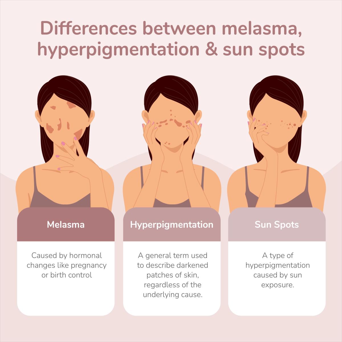 Chart outlining the differences between melasma, hyperpigmentation, and sun spots. Melasma is caused by hormonal changes like pregnancy or birth control. Hyperpigmentation is a general term used to describe darkened patches of skin, regardless of cause. Sun spots are caused by sun exposure.