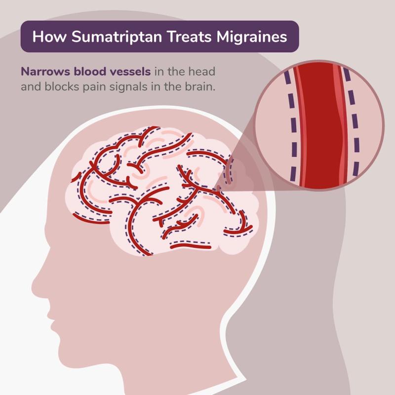 Illustration of How Sumatriptan Treats Migraines. Narrows Blood Vessels in the Head and Blocks Pain Signals in the Brain.