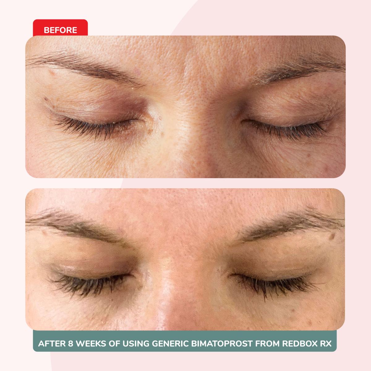 Bimatoprost (Generic Latisse) Eyelash Serum Before and After Photo (8 Weeks)