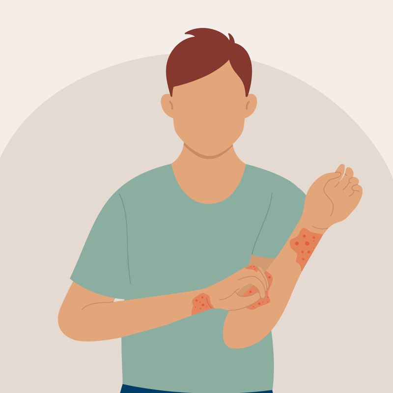 An illustration of a person affected by scabies.