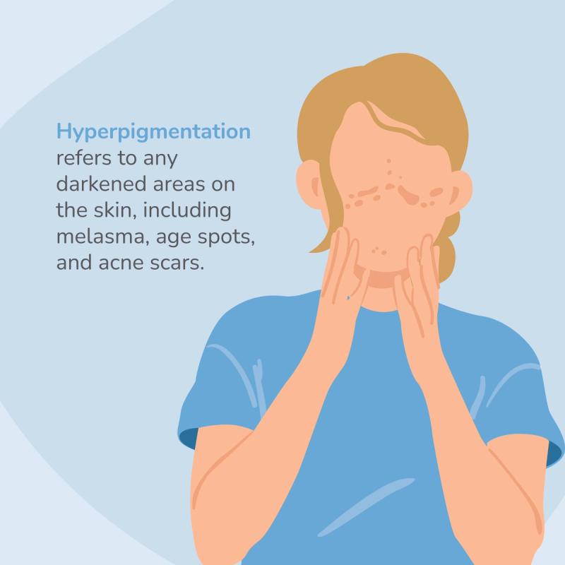 Illustration of someone with hyperpigmentation.
