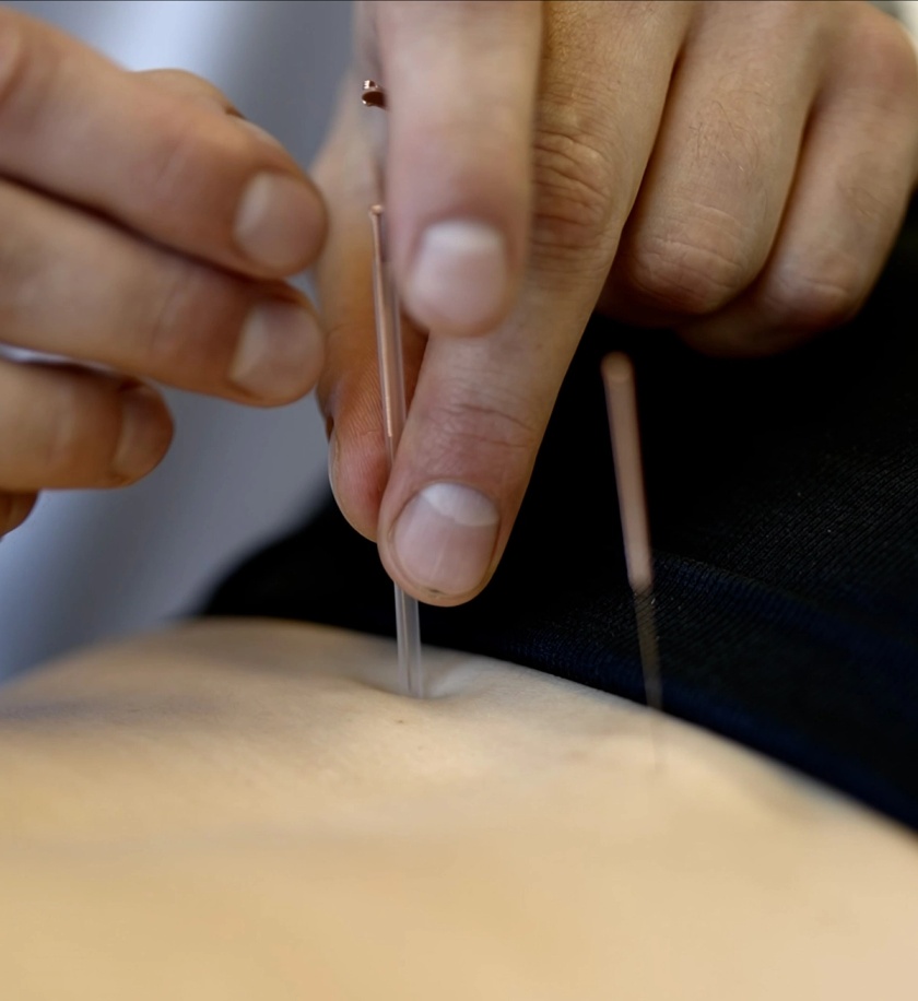 Acupuncture