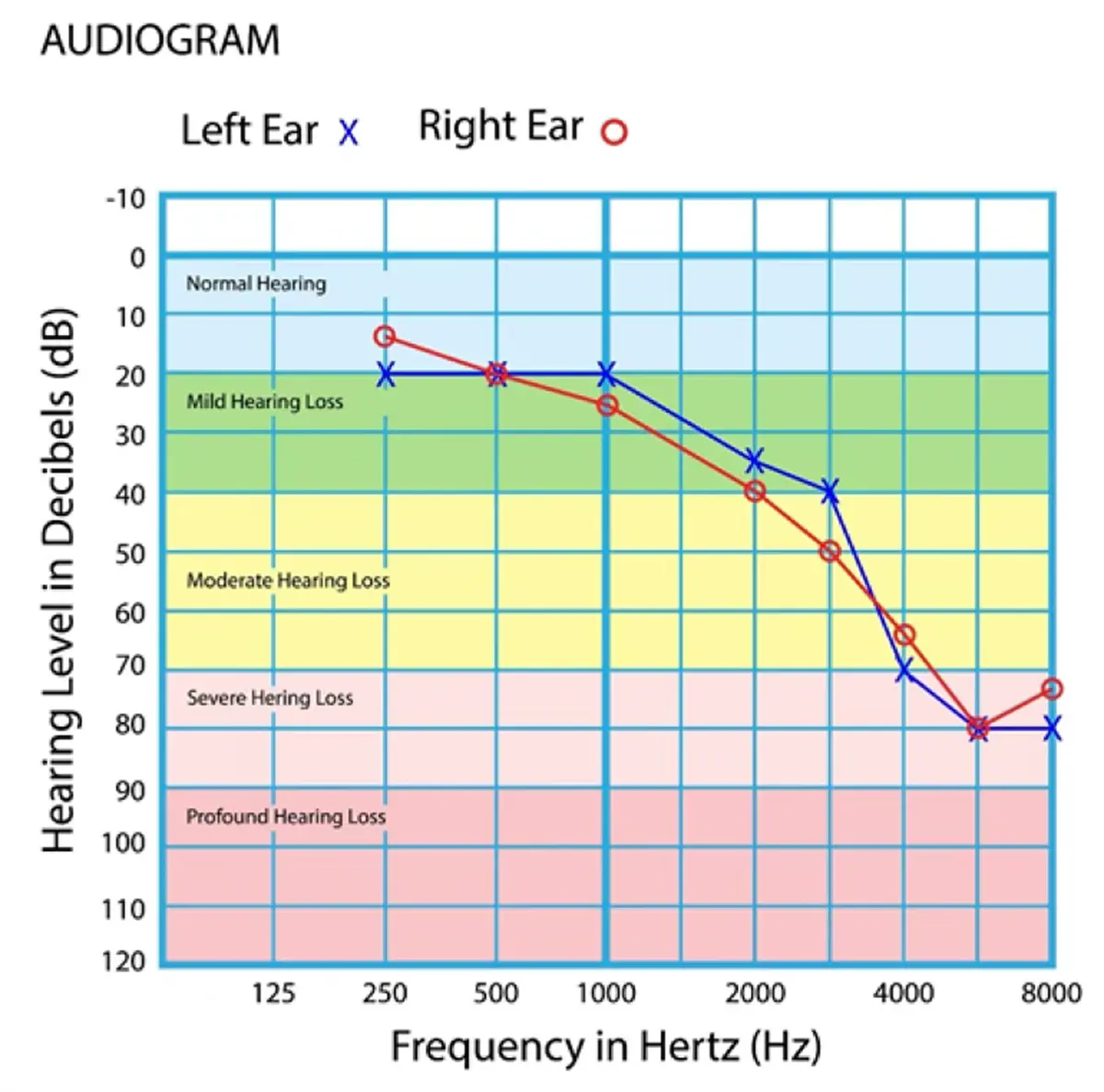 Audiogram by MDHearing showing sensorineural hearing loss