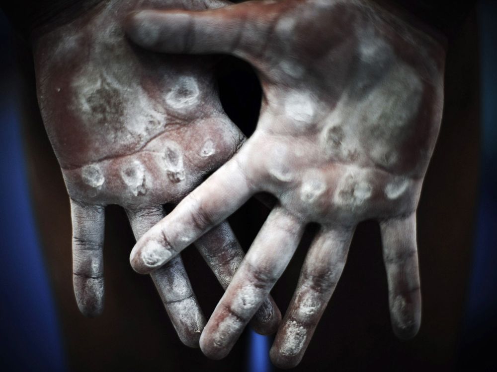 How to avoid calluses ripping off