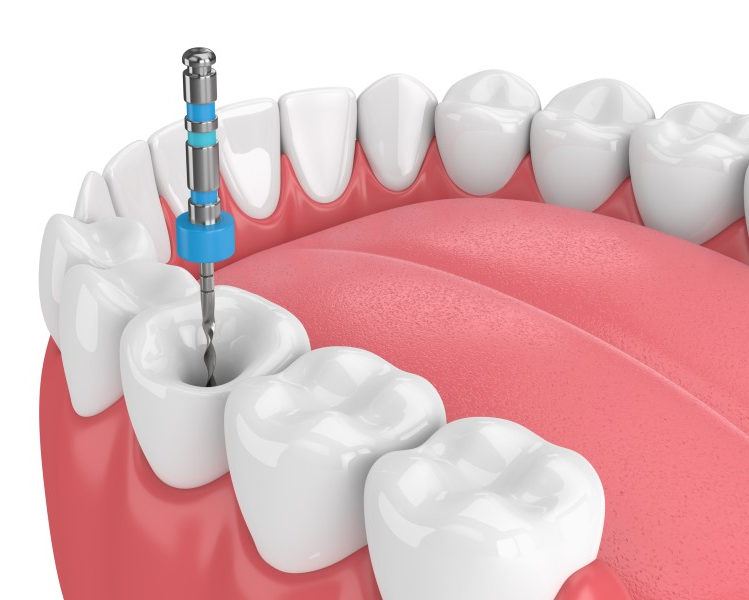 Root Canal Treatment