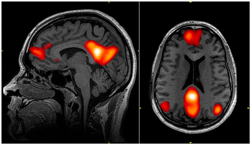 MRI scan of our brains default mode network