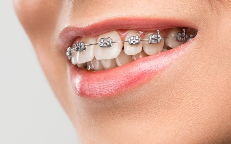 Ortodontia: por que alinhar os dentes vai muito além da estética