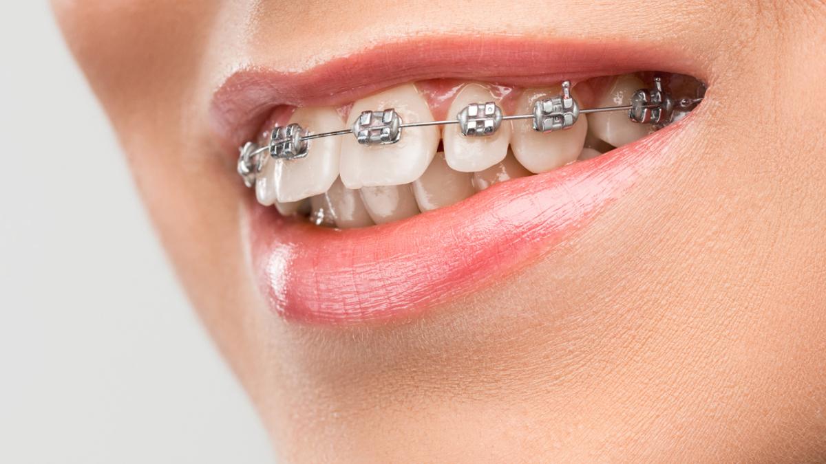Ortodontia: por que alinhar os dentes vai muito além da estética
