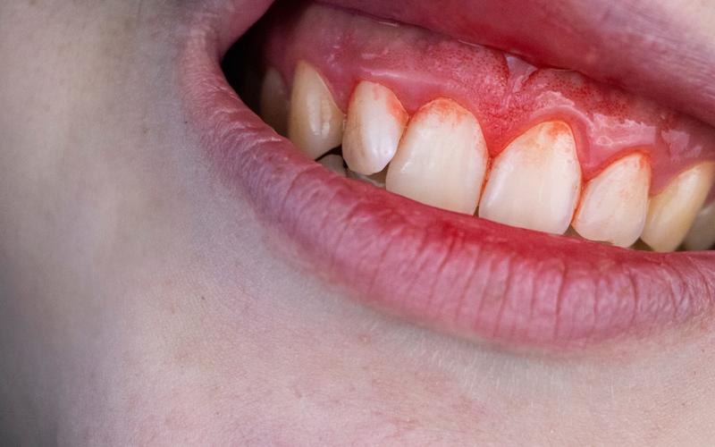 Periodontia: a saúde da gengiva é a base de um sorriso saudável