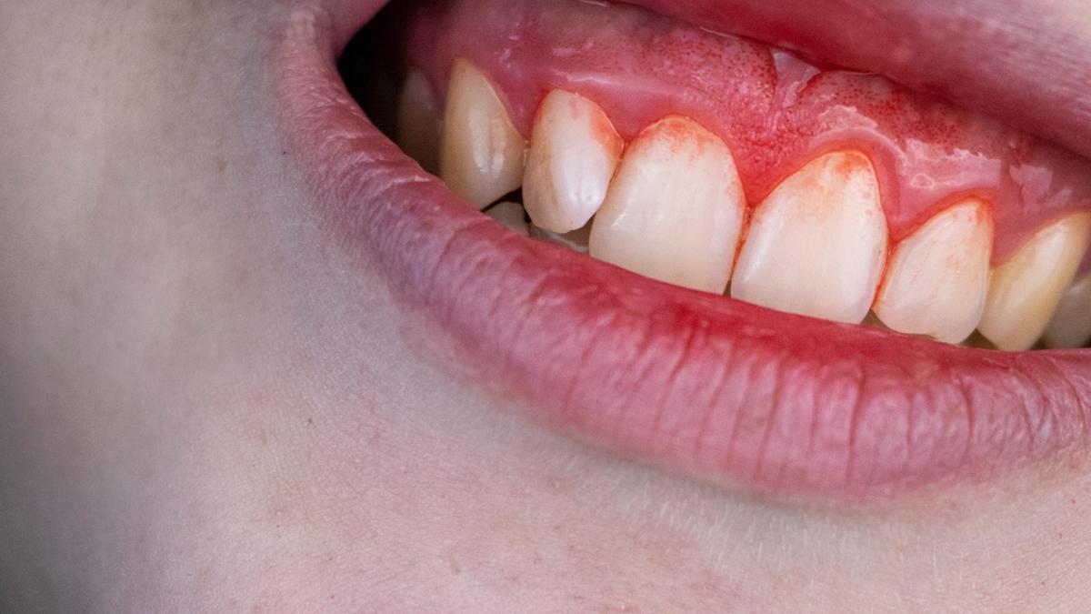 Periodontia: a saúde da gengiva é a base de um sorriso saudável