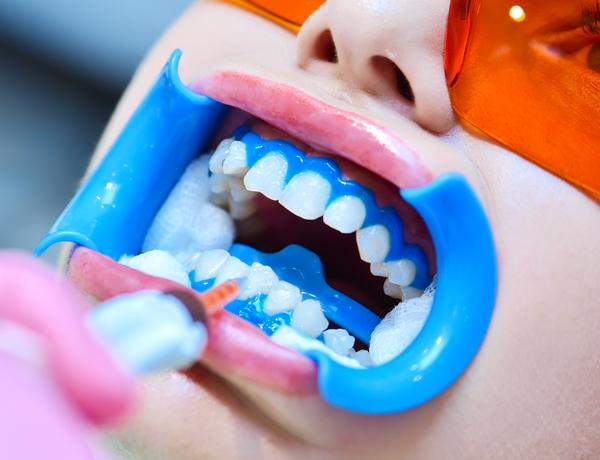 Clareamento dental