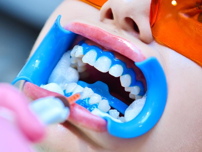 Clareamento dental