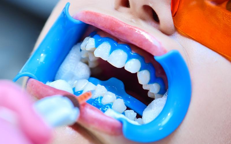 Clareamento dental: como funciona e por que fazer com acompanhamento