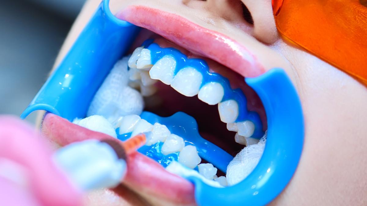Clareamento dental: como funciona e por que fazer com acompanhamento