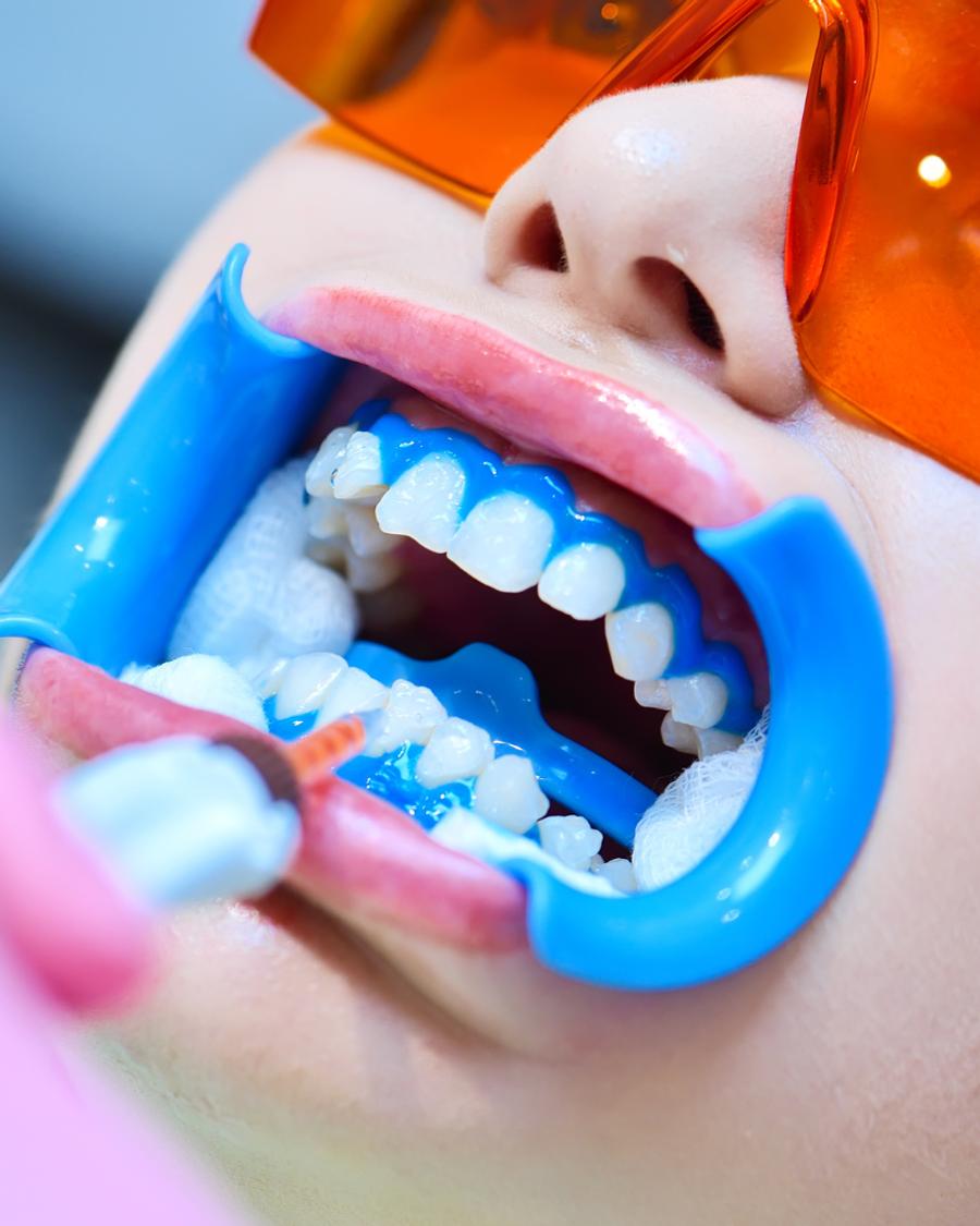 Clareamento dental