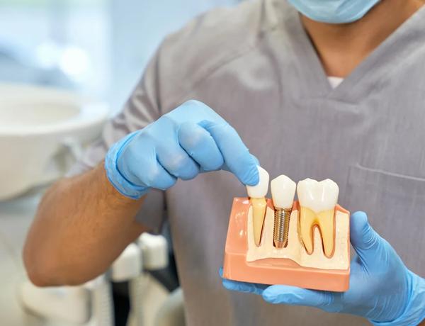 Implantes dentários