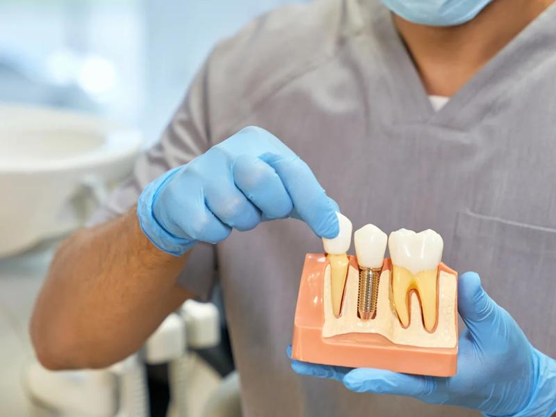 Implantes dentários