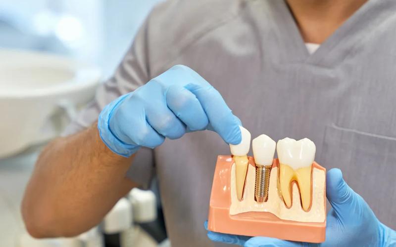 Implantes dentários: a solução moderna para dentes perdidos