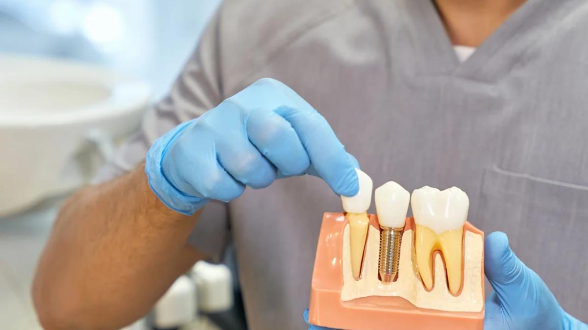 Implantes dentários: a solução moderna para dentes perdidos