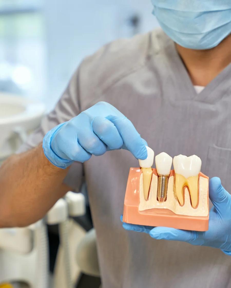 Implantes dentários