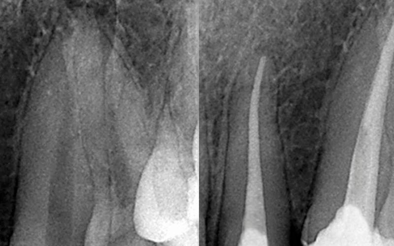 Tratamento de canal: a endodontia que salva o seu dente
