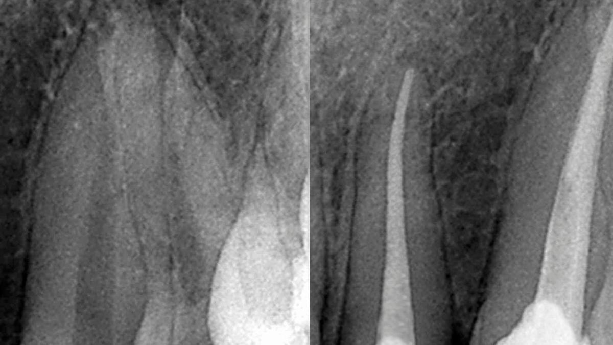 Tratamento de canal: a endodontia que salva o seu dente