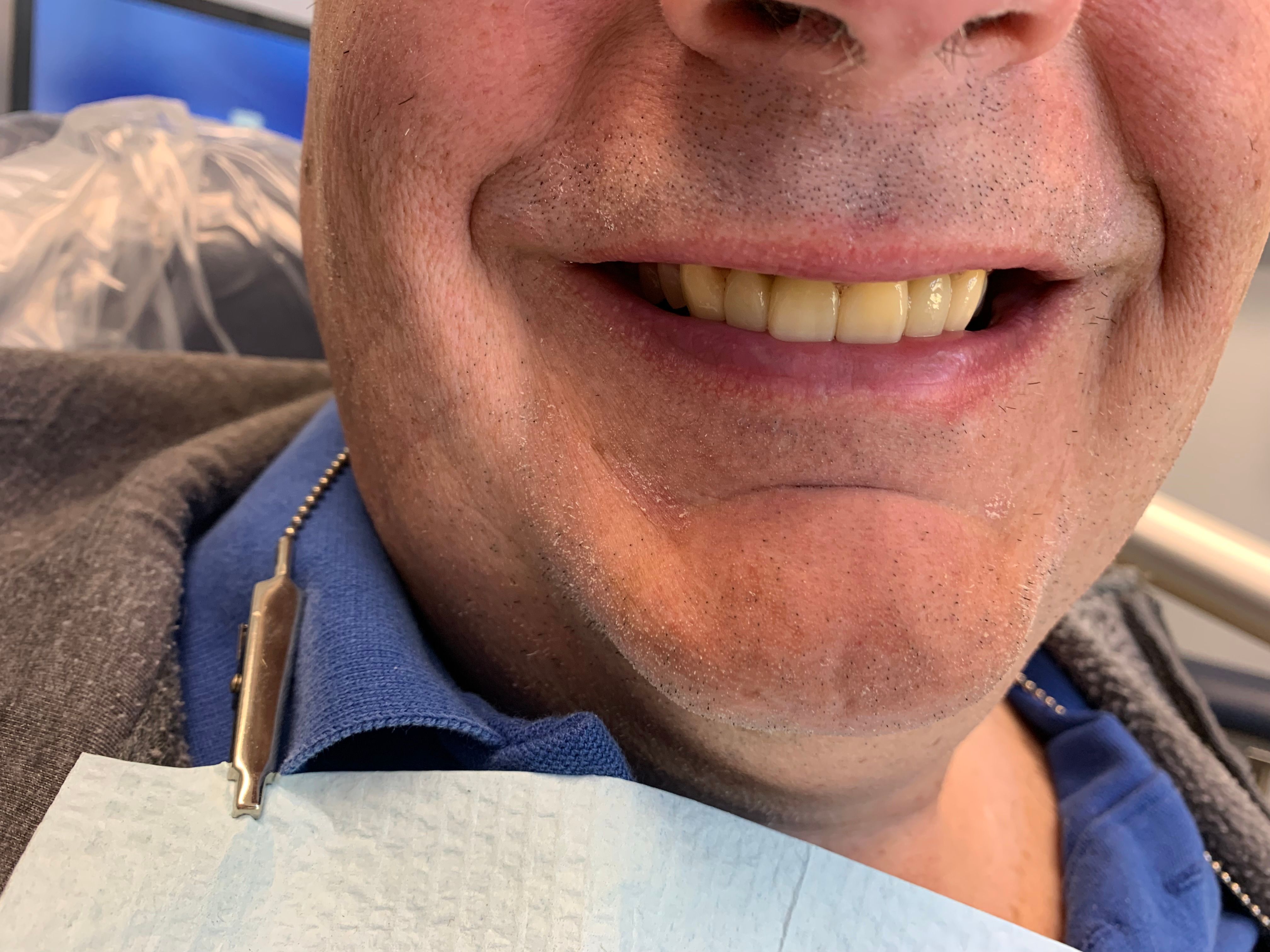 Close up of teeth after bridge