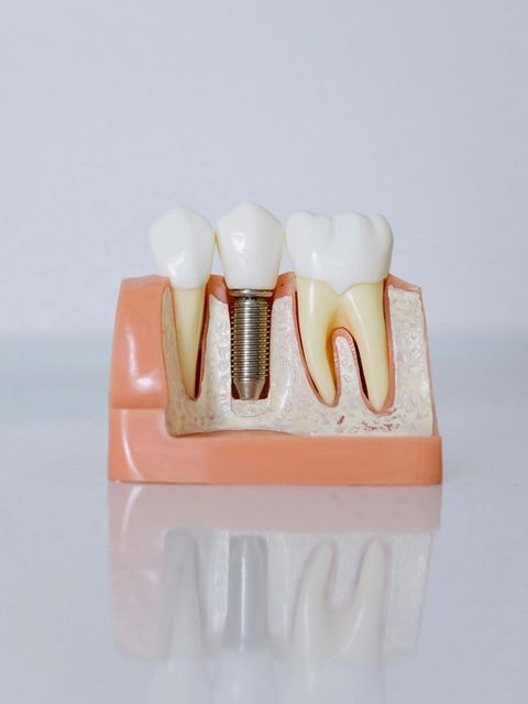 Dental implant