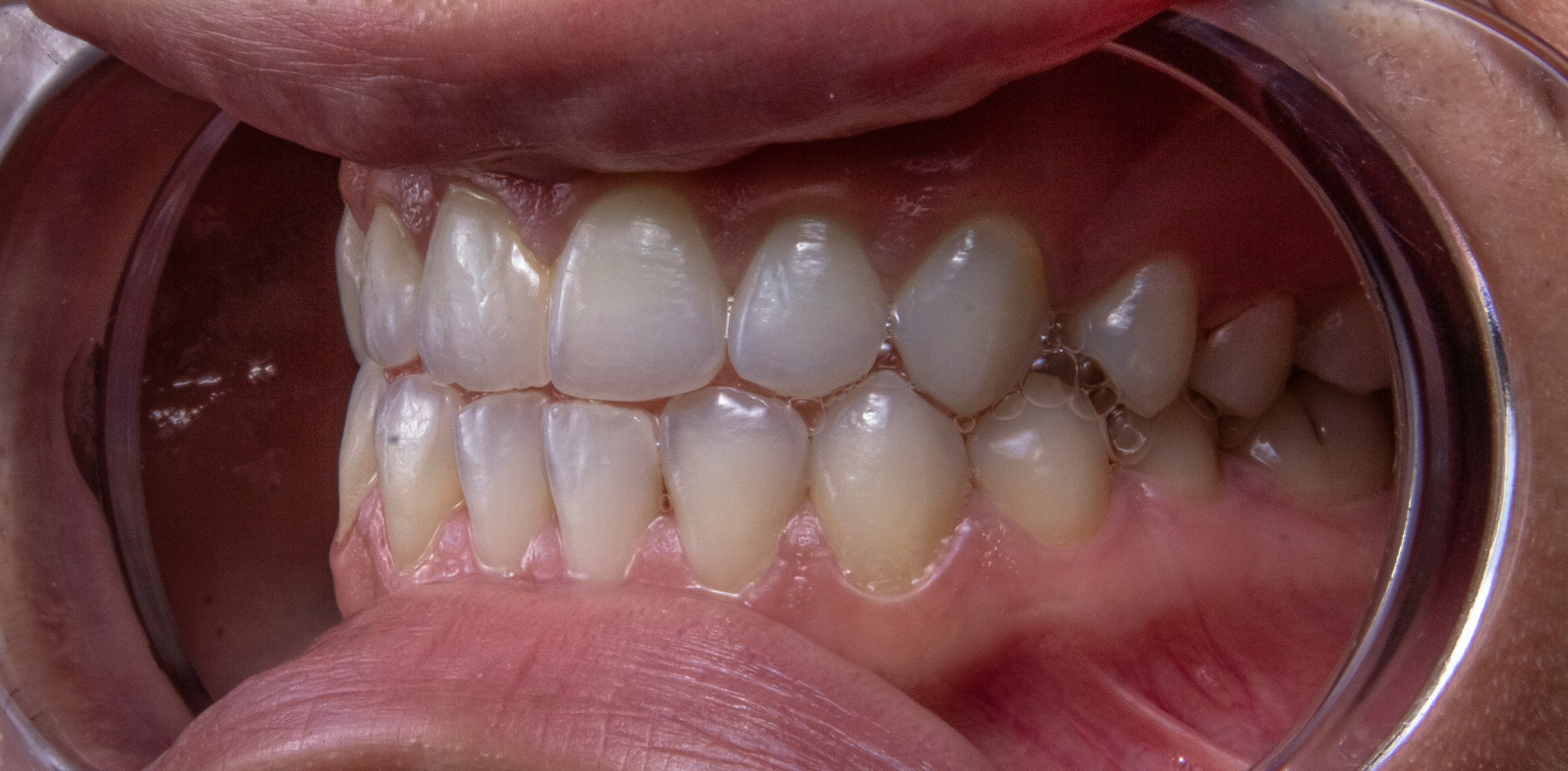 Tooth with filling