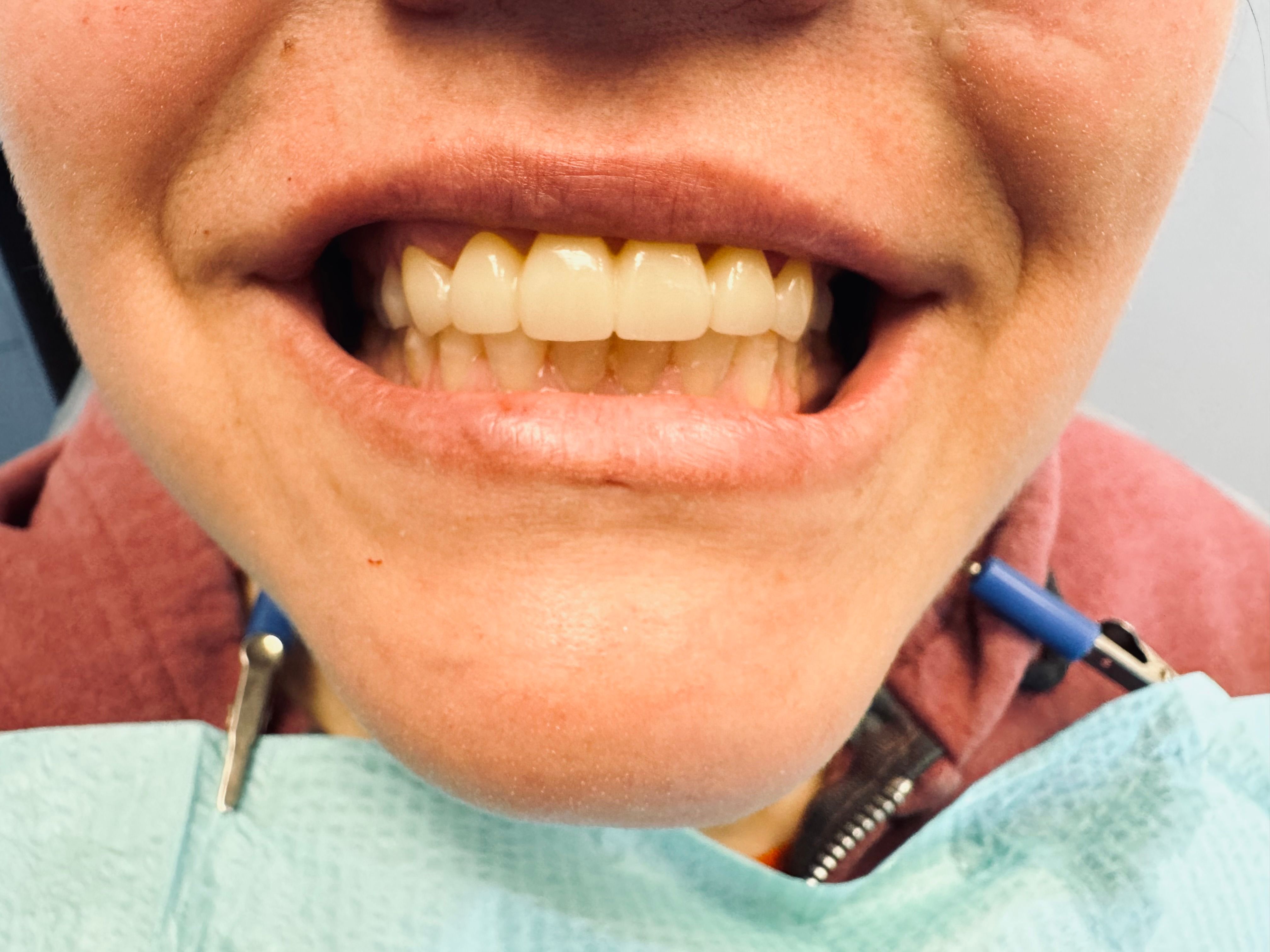 Close up of teeth after bridge