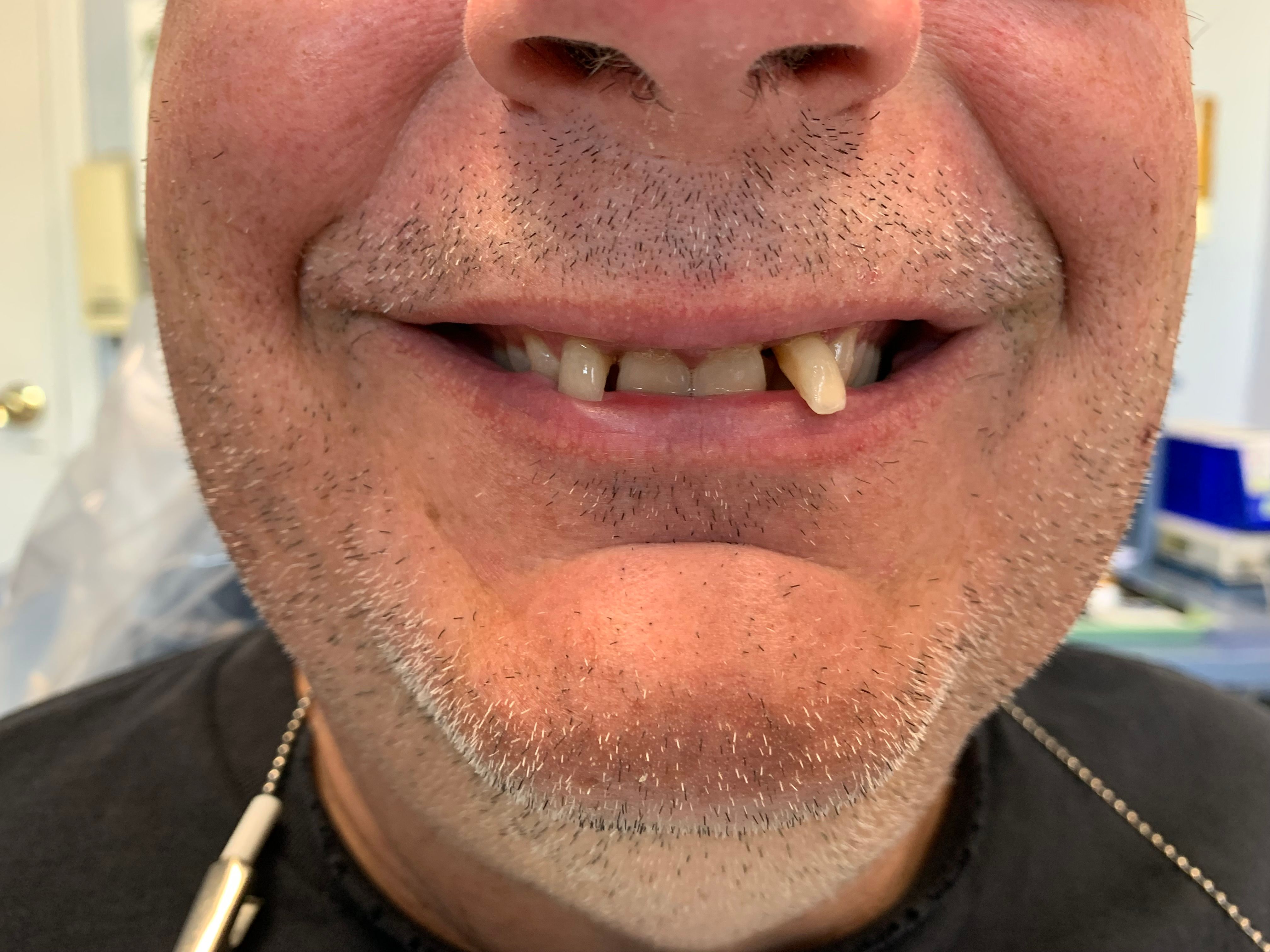 Close up before bridge