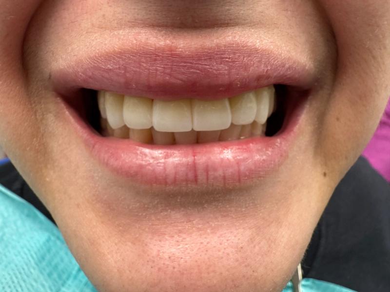 Close up of teeth after bridges and implants