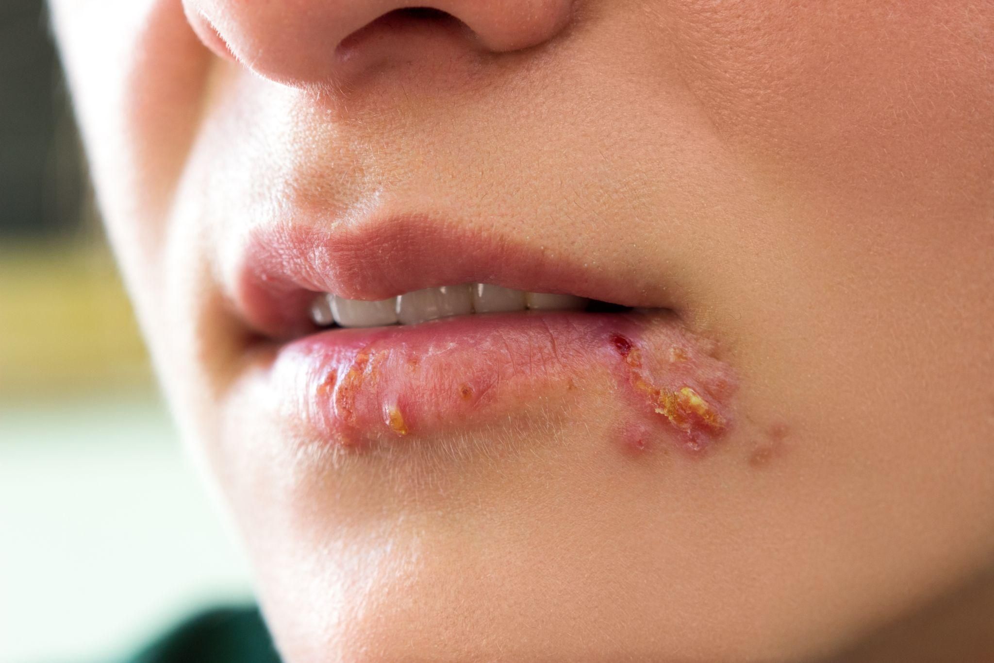 Cold Sores vs. Herpes: Understanding the Difference
